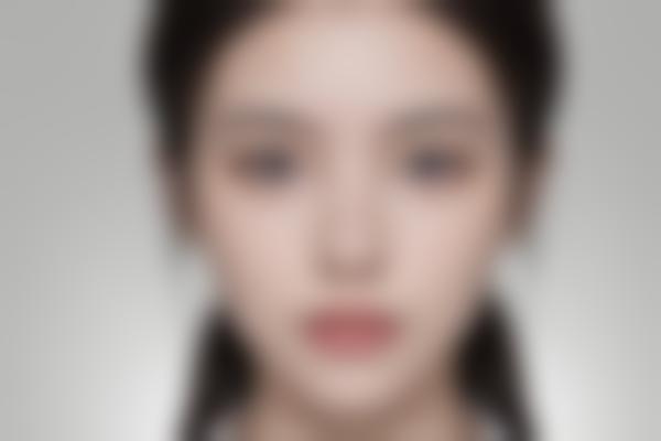 广州范丹医生整形修复好，范丹医生双眼皮隆鼻价格亲民自然！