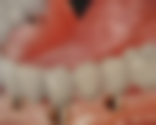 {北京市法国安卓健Anthogyt种植体多少钱？十家医院详情及价格参考来了