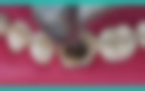 温州奥齿泰口腔王伟医生的收费价格表