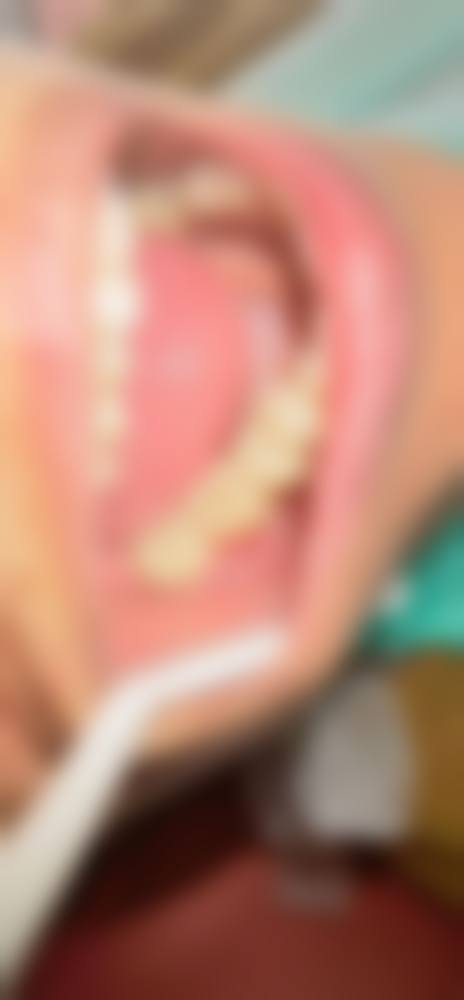 优惠活动详情:诚意满满的看牙补贴