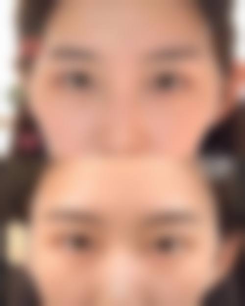 优惠活动详情:玻尿酸填充原价2800元-优惠价1680元